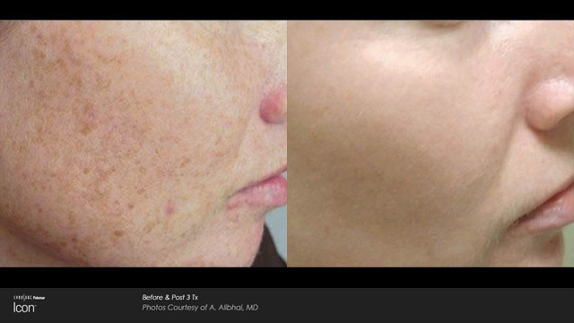 ICON Laser Before and After