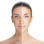 Woman before and after acne treatment