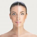 Woman before and after acne treatment